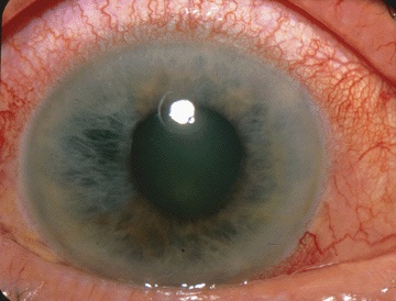 Imagen de Glaucoma de ángulo cerrado